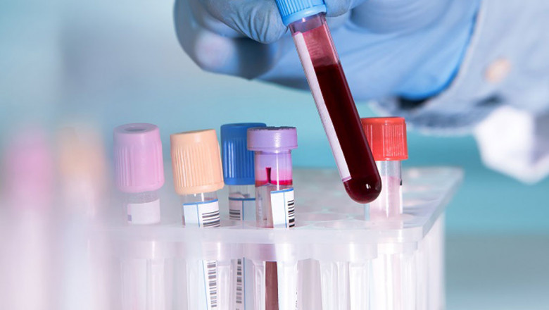 Blood Screening Is An Effective Method Of Preventing Infection Before Blood Donation