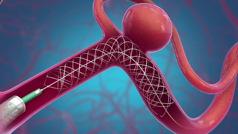 Statistical analysis of the global intracranial stents market, including size, share, trends, and forecasts to 2026