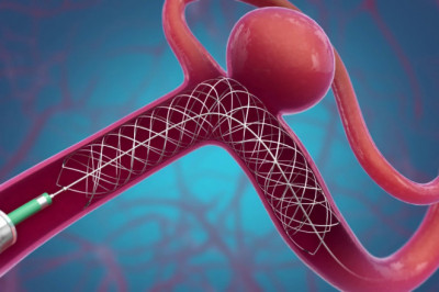 Statistical analysis of the global intracranial stents market, including size, share, trends, and forecasts to 2026