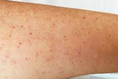 Immune Thrombocytopenia Market | Global Industry Trends, Segmentation, Business Opportunities & Forecast To 2028