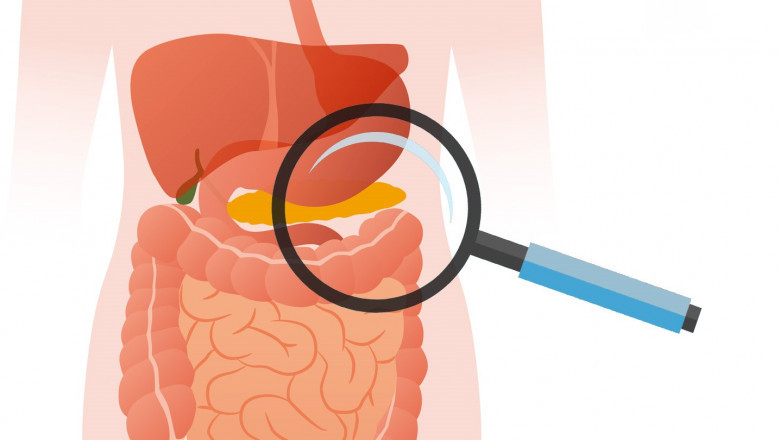 The Exocrine Pancreatic Insufficiency (EPI) Therapeutics Includes Enzyme Replacement And Dietary Changes