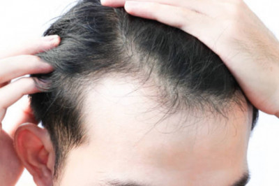 What Are The Disadvantages Of Recreating The Hairline?