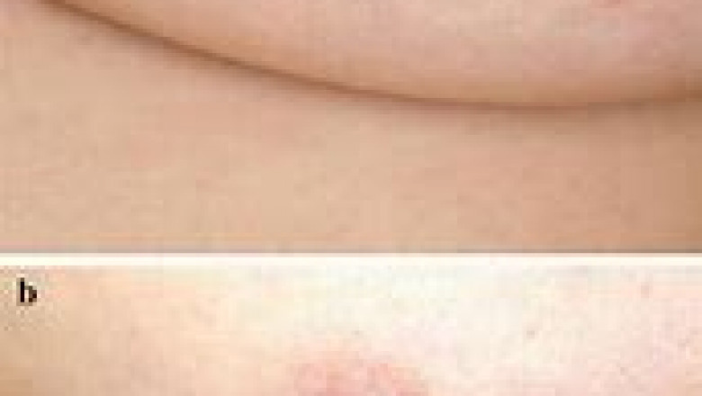 Folliculotropic Mycosis Fungoides Treatment Market Share, Size, Trends, Industry Analysis Report To 2028