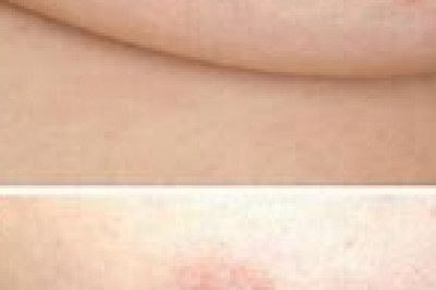 Folliculotropic Mycosis Fungoides Treatment Market Share, Size, Trends, Industry Analysis Report To 2028
