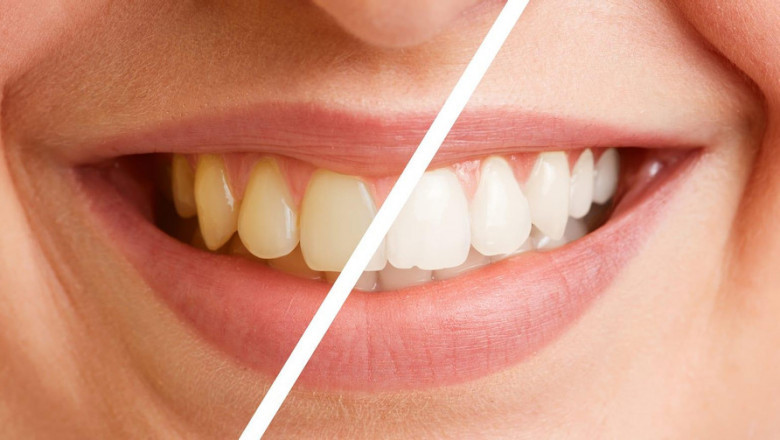 How Do Dentists Place Dental Veneers?