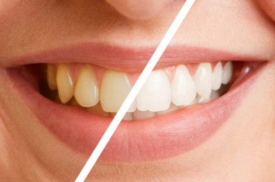 How Do Dentists Place Dental Veneers?