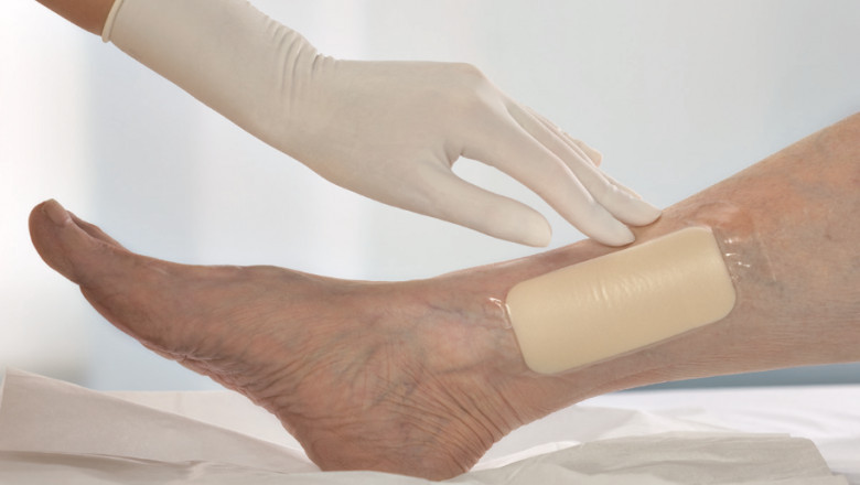 To Lessen The Bacterial Bioburden On The Colonised Wound, Foam Dressings With Antibacterial Substance Might Be Applied
