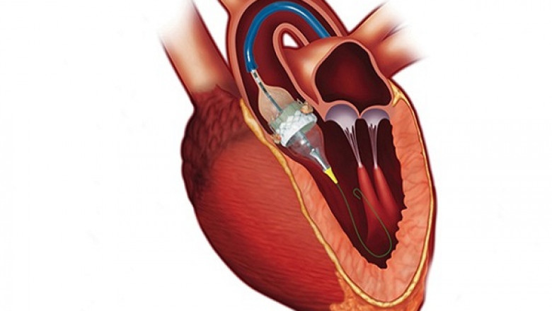 Transcatheter Aortic Valve Implantation (TAVI) Market Trends, Comprehensive Analysis, Company Latest News and Forecast to 2029
