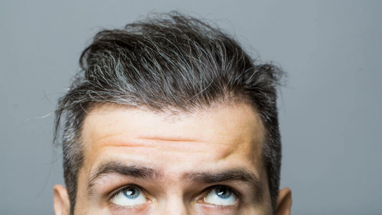 Examine This Report on Hair Loss Solution