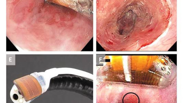 Global Cryoballoon Ablation System Market Report, Latest Trends, Industry Opportunity & Forecast to 2028