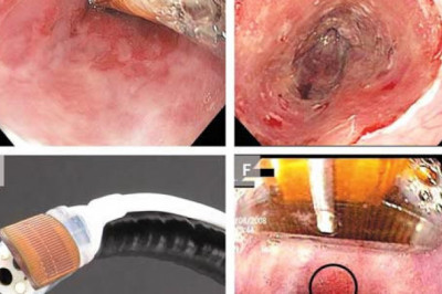 Global Cryoballoon Ablation System Market Report, Latest Trends, Industry Opportunity & Forecast to 2028