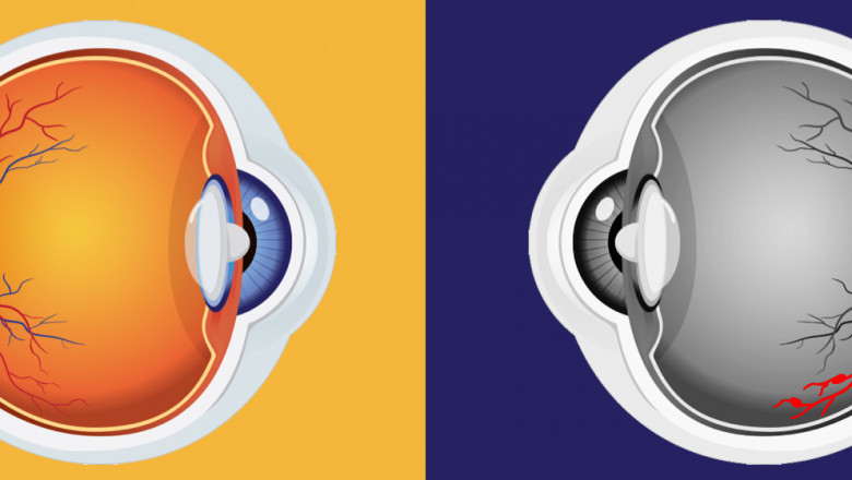 Macular Edema Treatment Is Very Effective At Reducing The Fluid In The Retina And Improving Vision