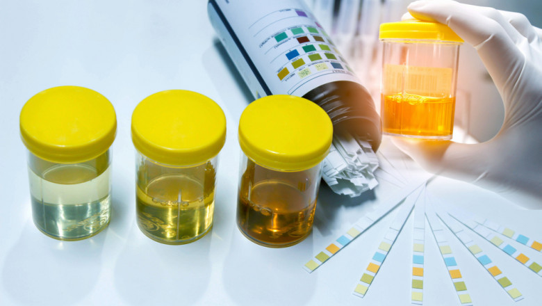 Global Urinalysis Market Analysis