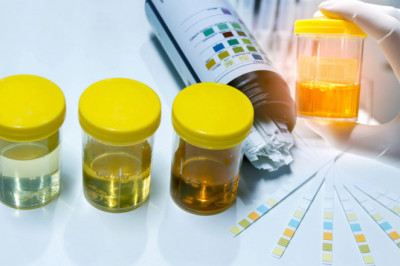 Global Urinalysis Market Analysis