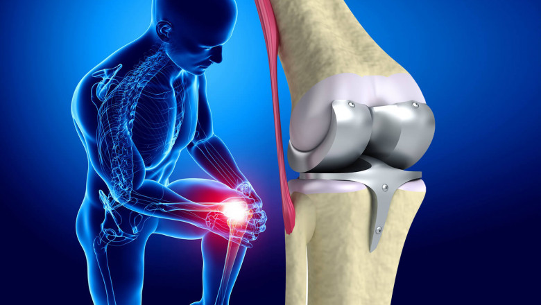 Knee Replacement Is the Most Effective Way to Relieve Your Pain