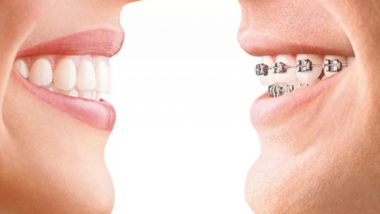 Orthodontics Market: Orthodontics To Grow at 16.5% CAGR During 2021-2028