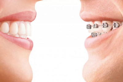 Orthodontics Market: Orthodontics To Grow at 16.5% CAGR During 2021-2028