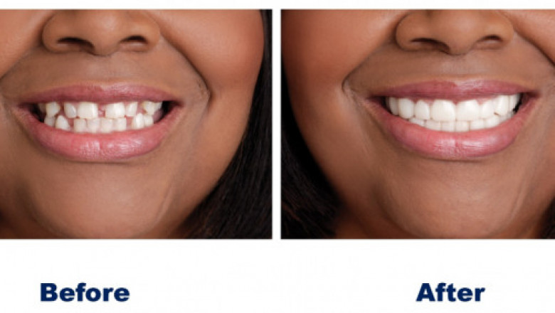 Affordable Invisalign Dentist Indian Land Sc | Carolinasmiledentistry.com