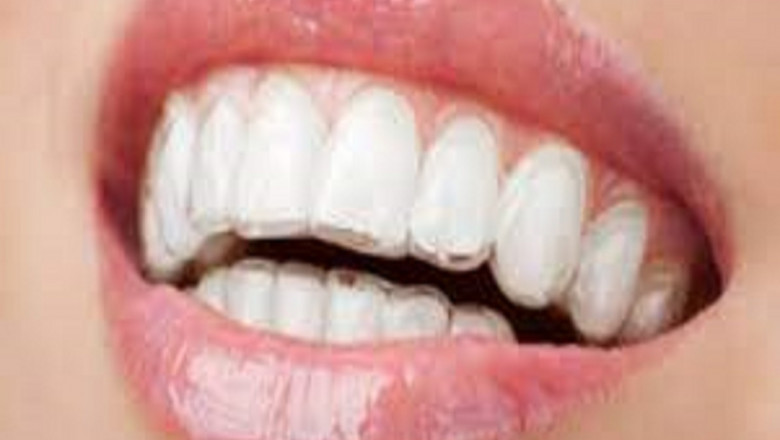 Clear Aligners Market Demand Analysis, Statistics, Industry Trends And Investment Opportunities To 2028