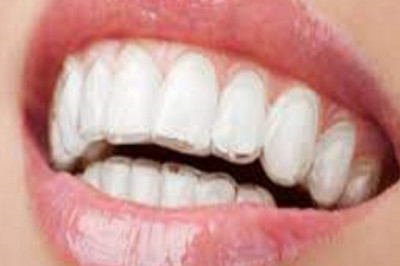 Clear Aligners Market Demand Analysis, Statistics, Industry Trends And Investment Opportunities To 2028