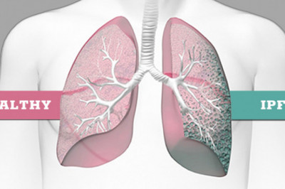 Idiopathic Pulmonary Fibrosis Treatment  Symptoms and Progression
