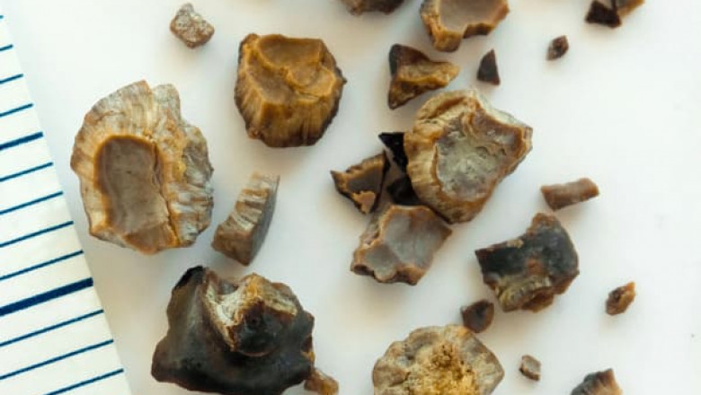 Kidney Stones