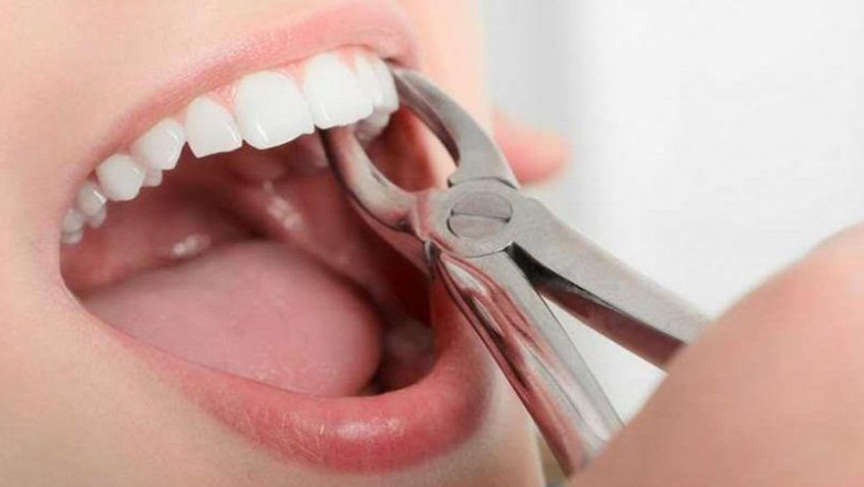 What Is The Procedure For Dental Crowns?