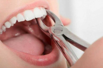 What Is The Procedure For Dental Crowns?