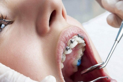 Why Does Orthodontic Treatment Matter For Adults?