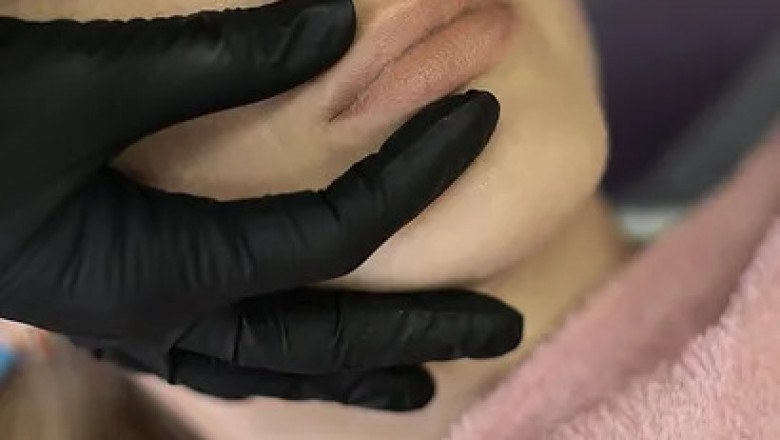 Best Lip Filler in Edmonton