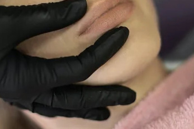 Best Lip Filler in Edmonton