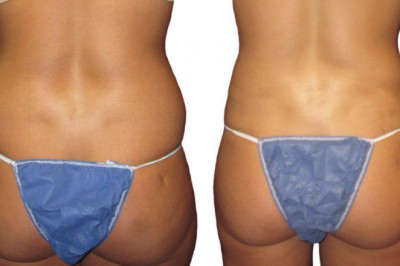 How to Choose The Best Surgeon For BBL Surgery?