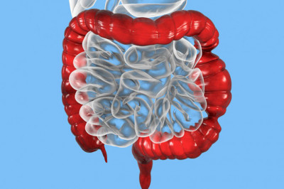 What is Short Bowel Syndrome?
