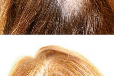 Best Prp Treatment In Edmonton CA | Balwin Aesthetics