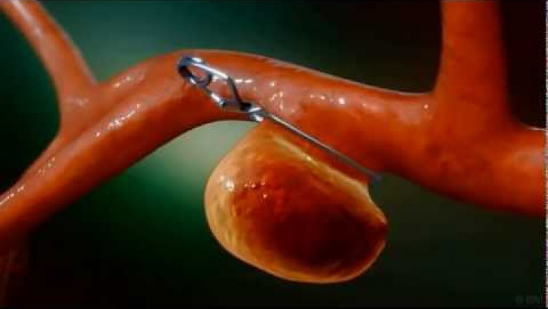 Cerebral Aneurysm Clips Market 2022 | Industry Demand, Fastest Growth, Opportunities Analysis and Forecast To 2028