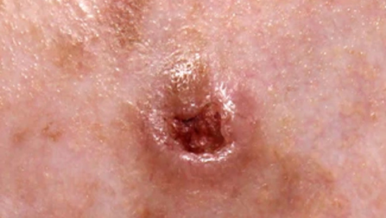 Basal Cell Carcinoma Treatment Market Size, Share, Trends & Forecast 2029