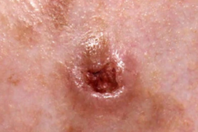 Basal Cell Carcinoma Treatment Market Size, Share, Trends & Forecast 2029