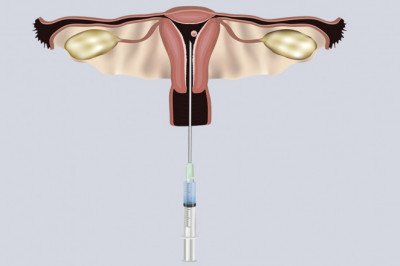 By Using Assistive Reproductive Technology,Infertility Issues Can Be Resolved While Maintaining Genetic Ties