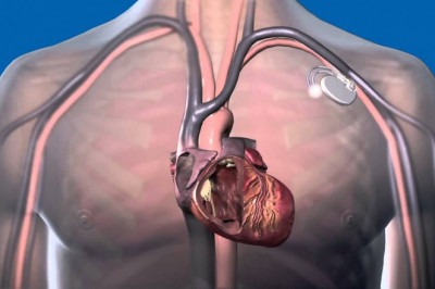 Global Cardiac Pacemaker : Trends, Size, Growth, Opportunity, and Forecast to 2022-2030