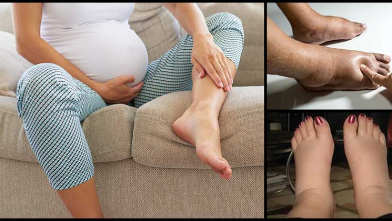 Swollen Feet During Pregnancy: Causes and Treatment