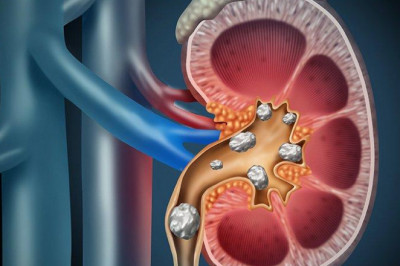Urolithiasis Management Devices are fiberoptic endoscopes used in minimally invasive procedures for removing kidney stones.