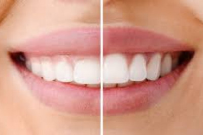 What Do You Know About The Gum Recession?