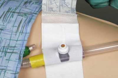 A study of the global Catheter Stabilization Devices Market: trends, market size, growth, opportunity, as well as forecasts for 2022-2028