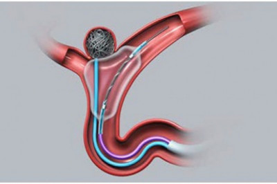 A study of the global Intracranial Stents Market: trends, market size, growth, opportunity, as well as forecasts for 2026