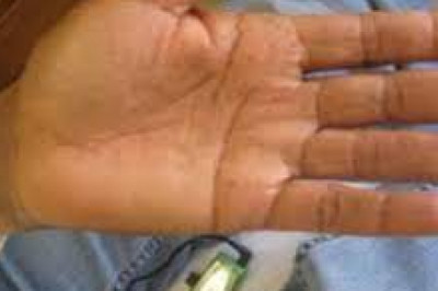 Acupuncture for Stress Relief