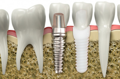 After Surgery, Bioimplants Can Be Used To Treat Skin Burns Or Sores Of The Skin