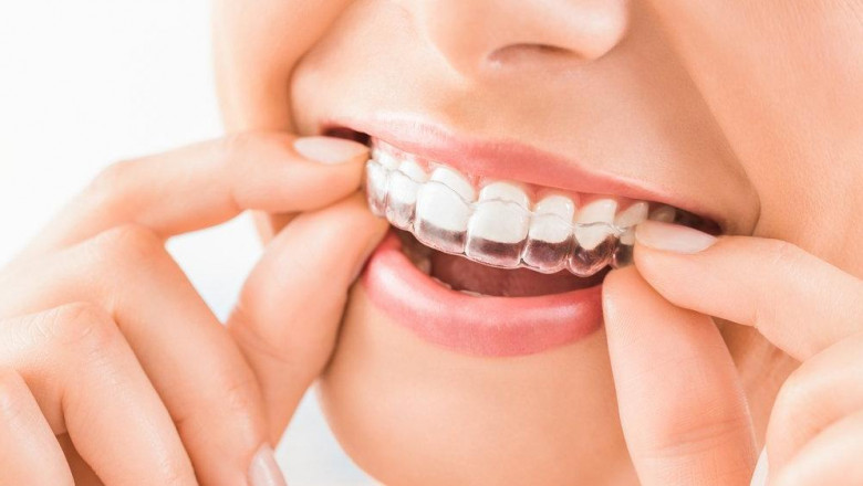 Clear Aligners Are Transparent Trays Used To Straighten Teeth