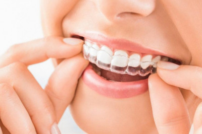 Clear Aligners Are Transparent Trays Used To Straighten Teeth