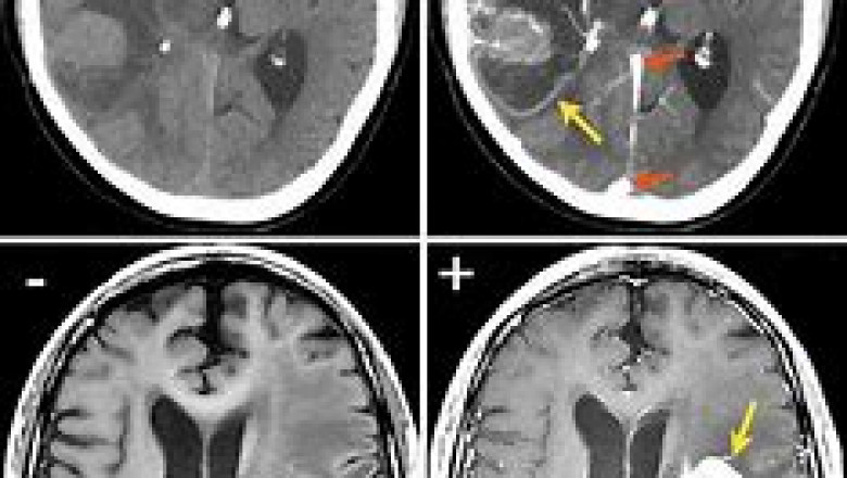 CT Contrast Media Market Analysis | Recent COVID-19 Impact and Industry Trends Report, 2028
