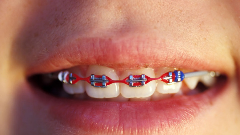 Everything you need to know about Braces | Braces And Aligners - The Dental Home